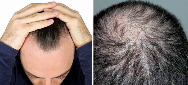 Łysienie androgenowe, utrata włosów z powodu braku odpowiednich składników odżywczych, niedoboru mikroelementów czy nawet nieregularny tryb życia, to najczęstsze przyczyny utraty włosów. Niezwykle ważną przyczyną wypadania włosów są problemy skóry głowy związane z nadmiernym wydzielaniem sebum, powstawaniem stanów zapalnych. Łojotok, zapalenie mieszków włosowych może stać się bezpośrednią przyczyną wypadania włosów.