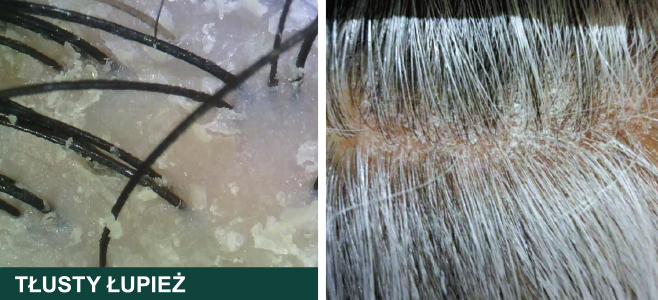 Łupież tłusty jest jednym z najczęstszych problemów skóry głowy powodowanych przez drożdżaki Malassezia.